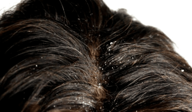 Les pellicules : les causes et les solutions